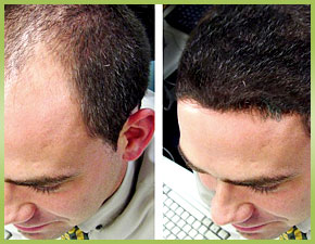 What Is the Procedure for Treating Hair Loss in Sarasota, Florida?