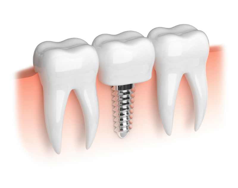 Finding Dental Implants Charleston, SC – Easy Thing!