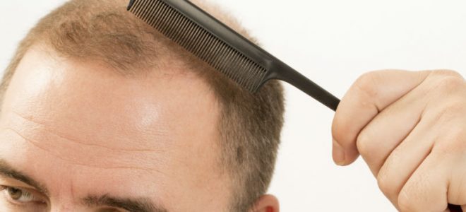 3 Reasons Why a Hair Transplant For Men in McLean, VA May Be Right For You